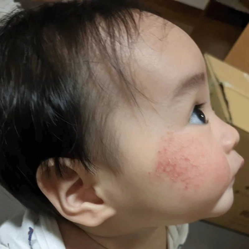 赤ちゃんの肌トラブル