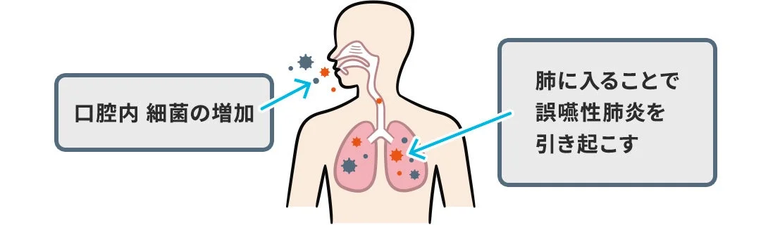 口腔内の細菌が増加し誤嚥性肺炎を引き起こすメカニズム
